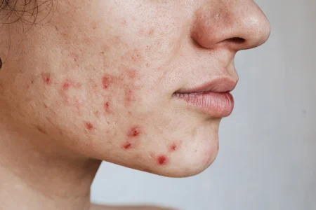 Close-up_of_the_skin_of_a_young_girl_with_acne_problem Close-up_of_the_skin_of_a_young_girl_with_acne_problem